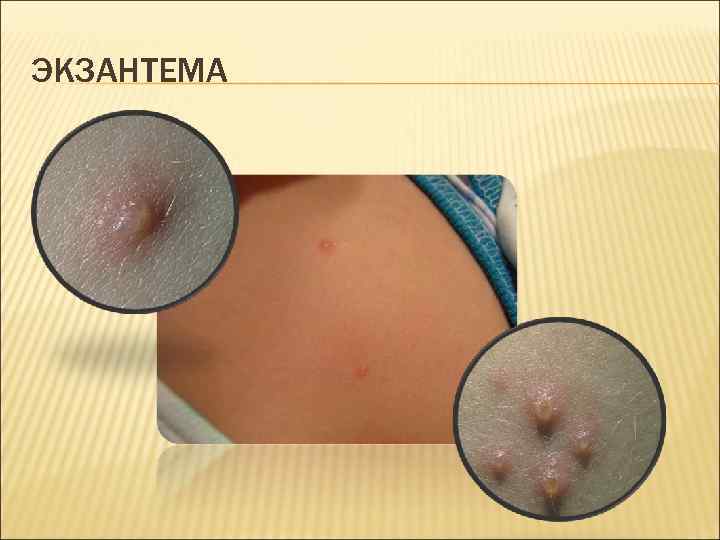 ЭКЗАНТЕМА 