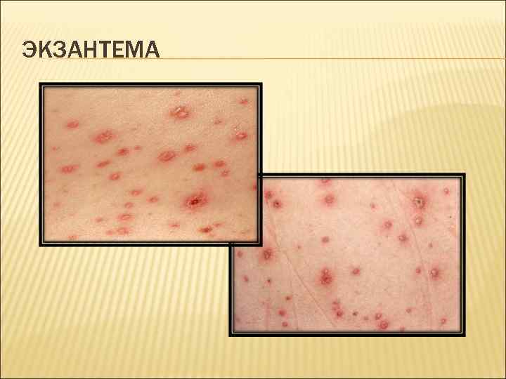 ЭКЗАНТЕМА 