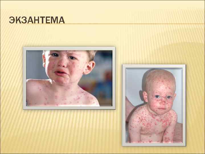 ЭКЗАНТЕМА 
