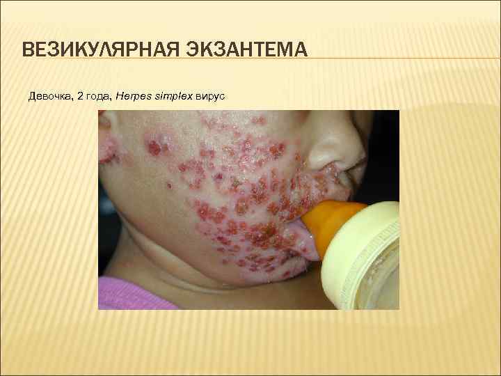 ВЕЗИКУЛЯРНАЯ ЭКЗАНТЕМА Девочка, 2 года, Herpes simplex вирус 