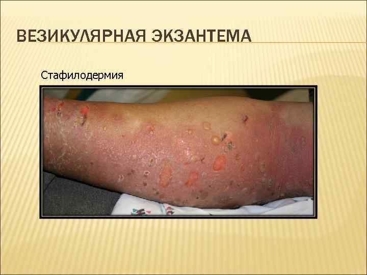 ВЕЗИКУЛЯРНАЯ ЭКЗАНТЕМА Стафилодермия 