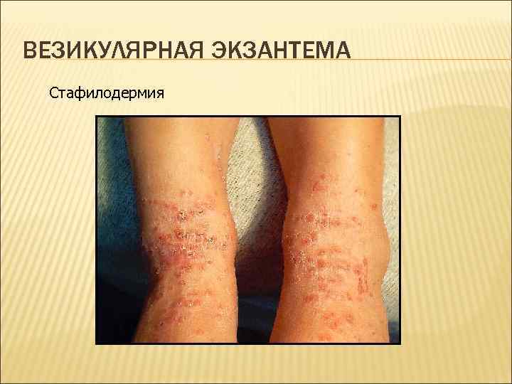 ВЕЗИКУЛЯРНАЯ ЭКЗАНТЕМА Стафилодермия 