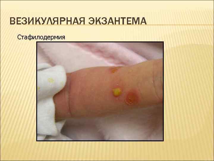 ВЕЗИКУЛЯРНАЯ ЭКЗАНТЕМА Стафилодермия 