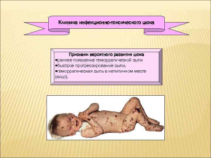 Клиника инфекционно-токсического шока Признаки вероятного развития шока ·раннее появление геморрагической сыпи ·быстрое прогрессирование сыпи.