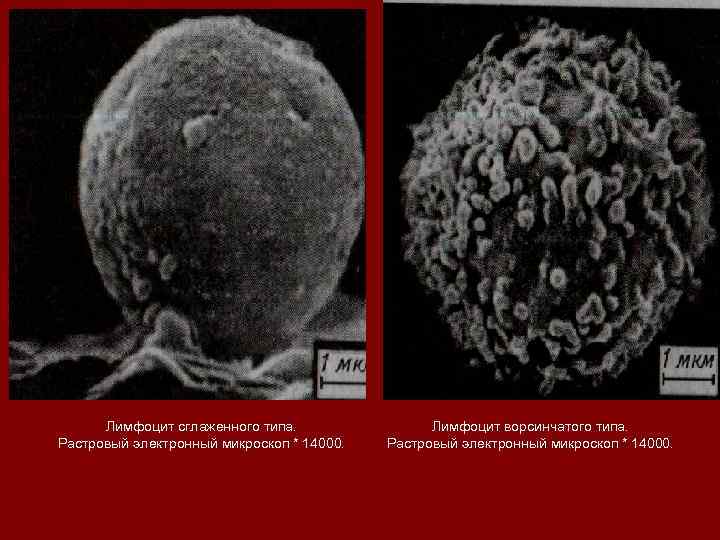 Лимфоцит сглаженного типа. Растровый электронный микроскоп * 14000. Лимфоцит ворсинчатого типа. Растровый электронный микроскоп