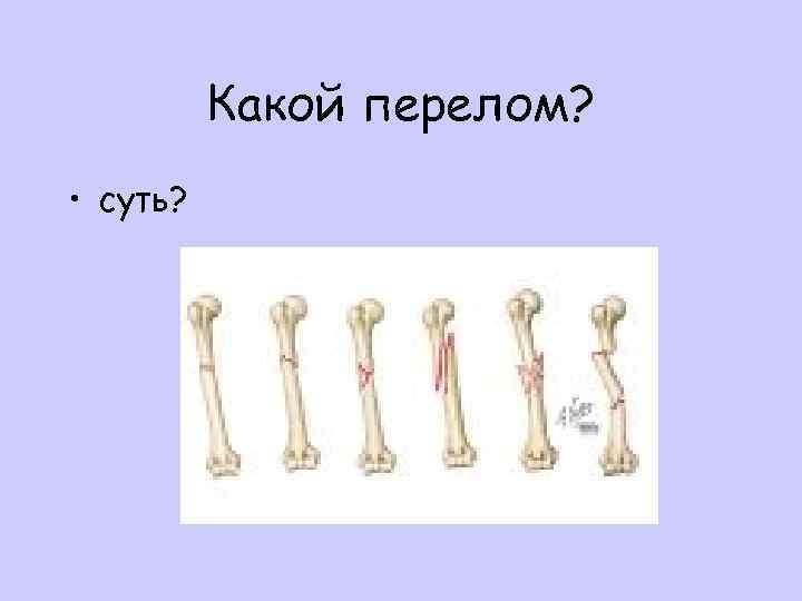 Какой перелом? • суть? 