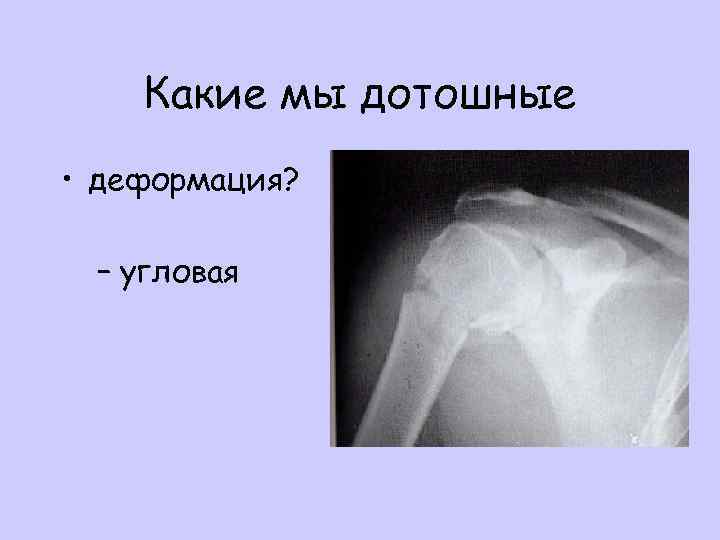 Какие мы дотошные • деформация? – угловая 