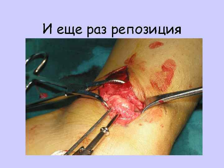 И еще раз репозиция 