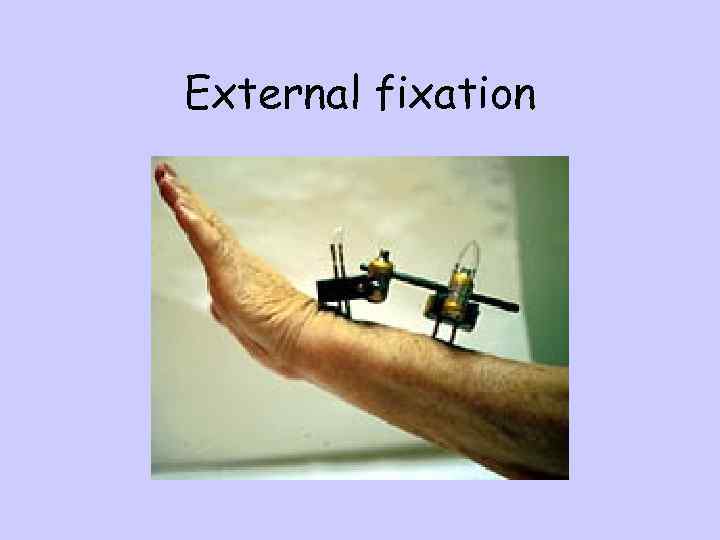 External fixation 