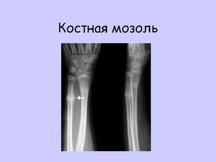 Костная мозоль 