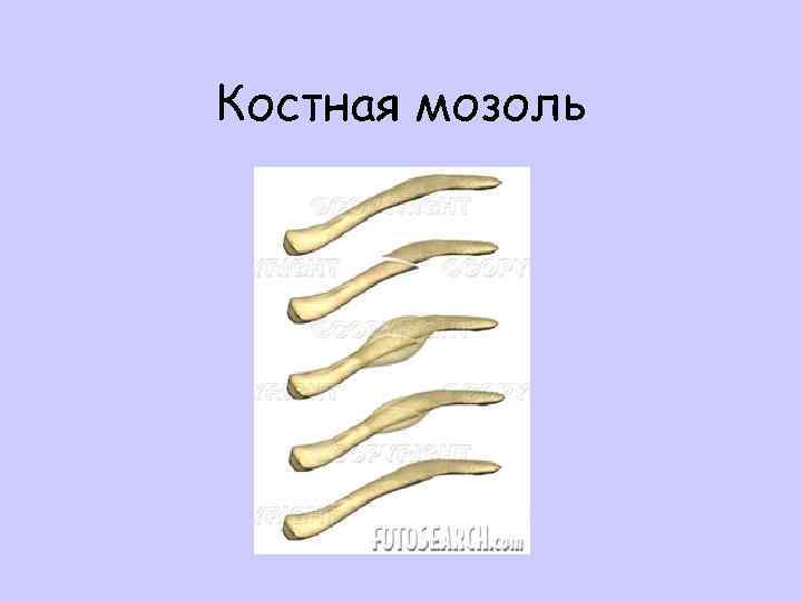 Костная мозоль 