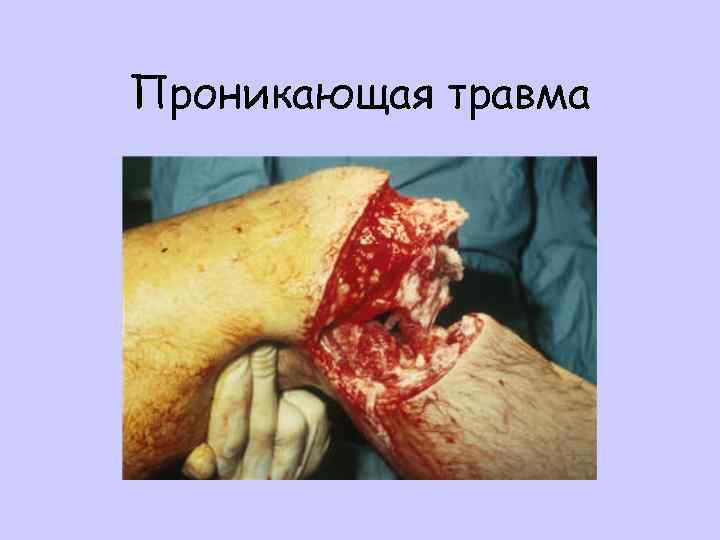 Проникающая травма 
