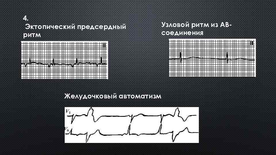 Эктопический ритм