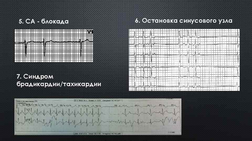 Лекция по теме Синдром слабости синусового узла и мерцательная аритмия 