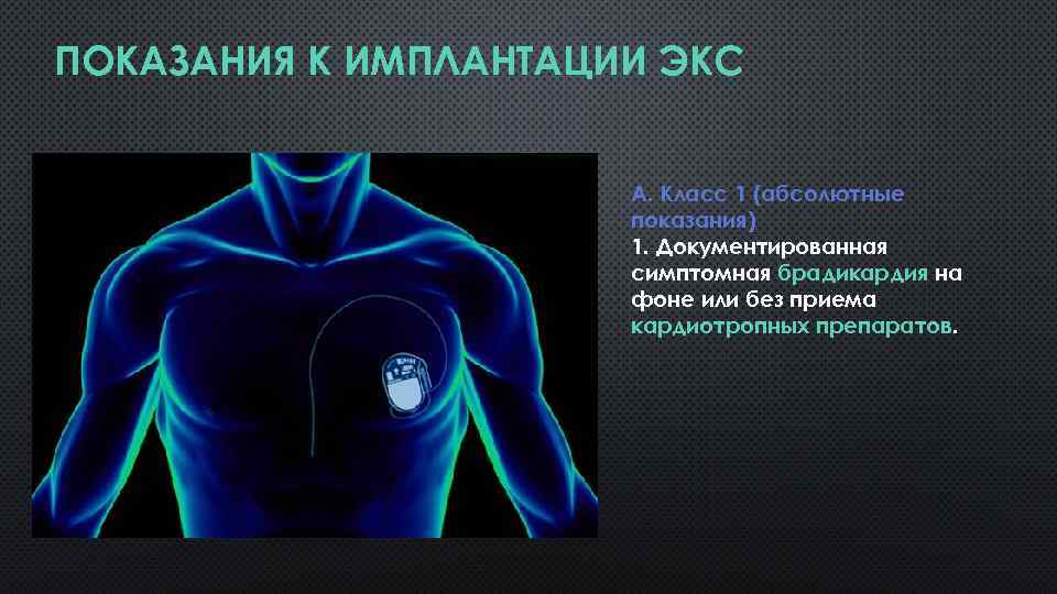 ПОКАЗАНИЯ К ИМПЛАНТАЦИИ ЭКС А. Класс 1 (абсолютные показания) 1. Документированная симптомная брадикардия на