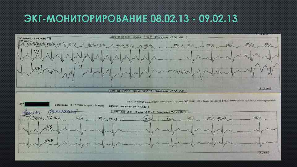 ЭКГ-МОНИТОРИРОВАНИЕ 08. 02. 13 - 09. 02. 13 