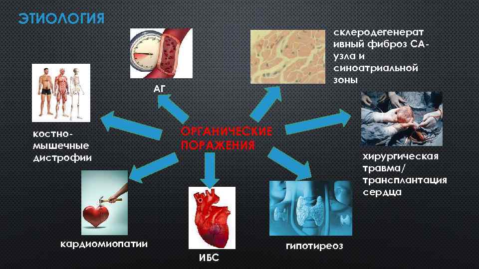 ЭТИОЛОГИЯ склеродегенерат ивный фиброз САузла и синоатриальной зоны АГ костномышечные дистрофии ОРГАНИЧЕСКИЕ ПОРАЖЕНИЯ кардиомиопатии