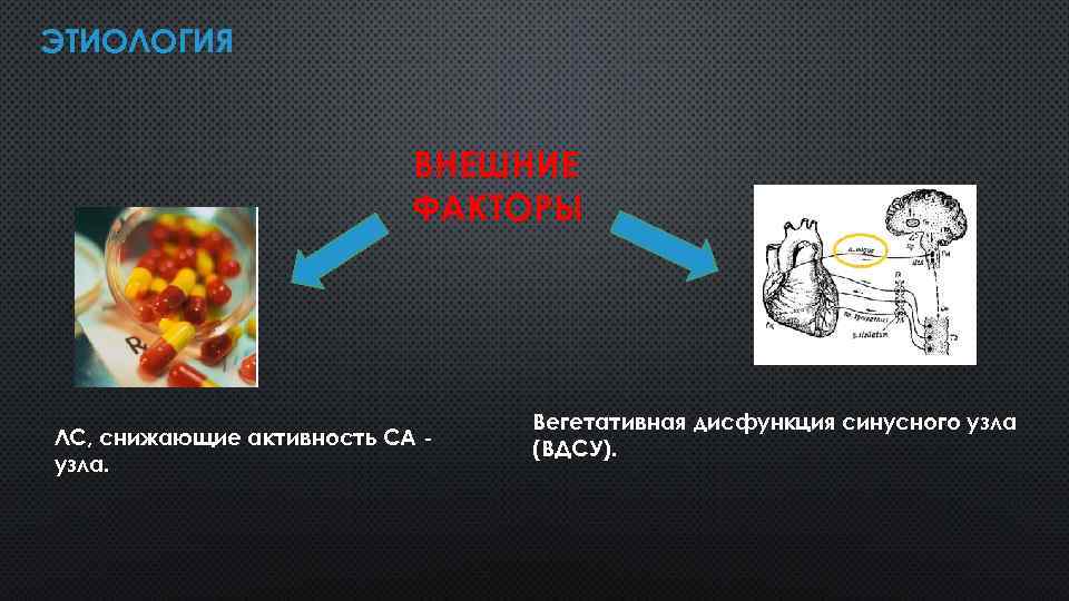 ЭТИОЛОГИЯ ВНЕШНИЕ ФАКТОРЫ ЛС, снижающие активность СА узла. Вегетативная дисфункция синусного узла (ВДСУ). 