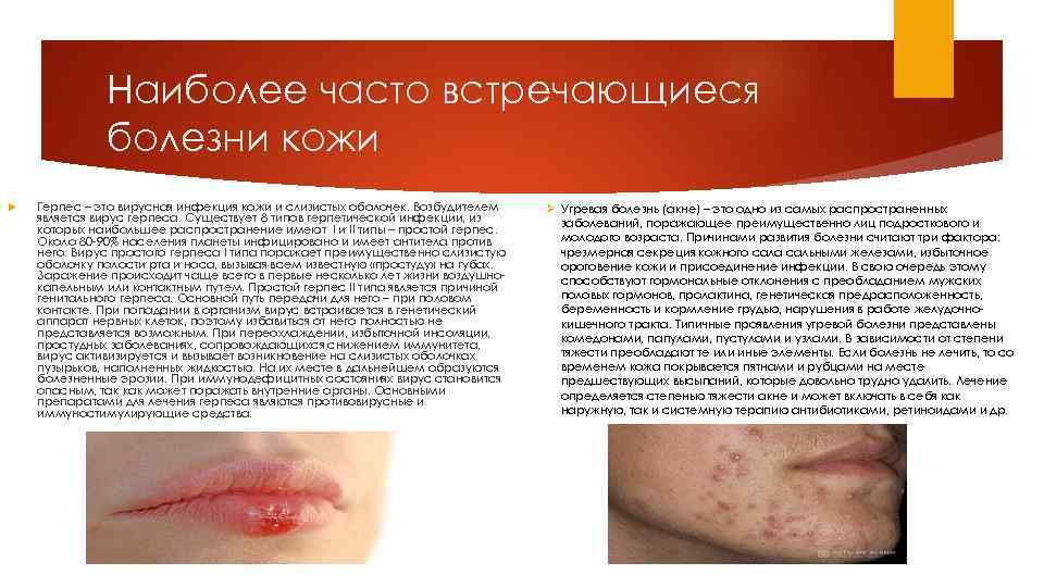 Наиболее часто встречающиеся болезни кожи Герпес – это вирусная инфекция кожи и слизистых оболочек.