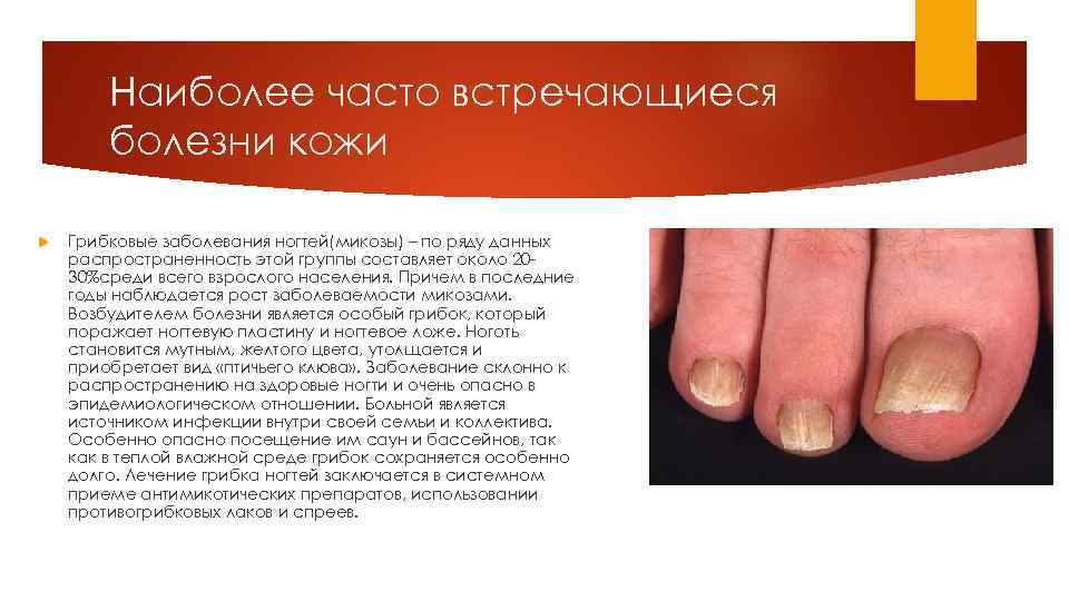 Наиболее часто встречающиеся болезни кожи Грибковые заболевания ногтей(микозы) – по ряду данных распространенность этой