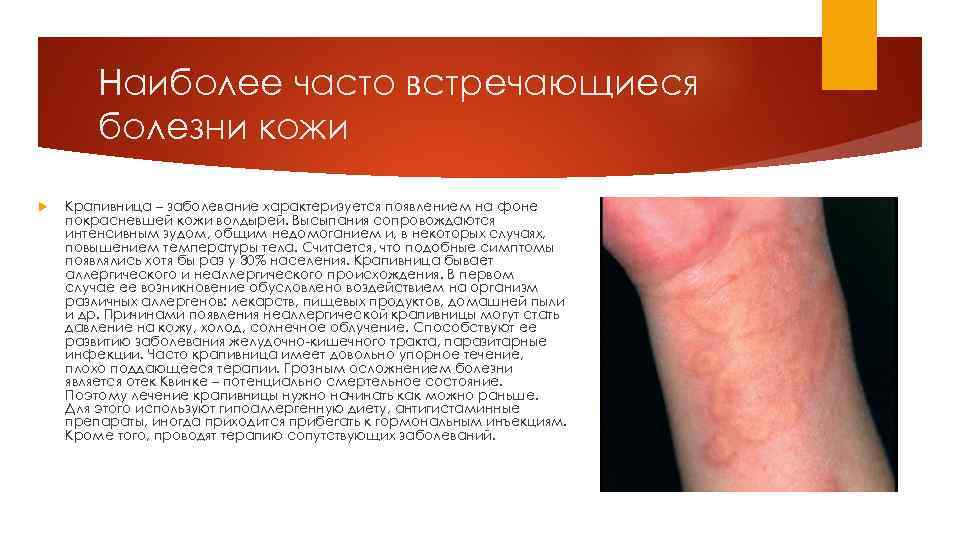 Наиболее часто встречающиеся болезни кожи Крапивница – заболевание характеризуется появлением на фоне покрасневшей кожи