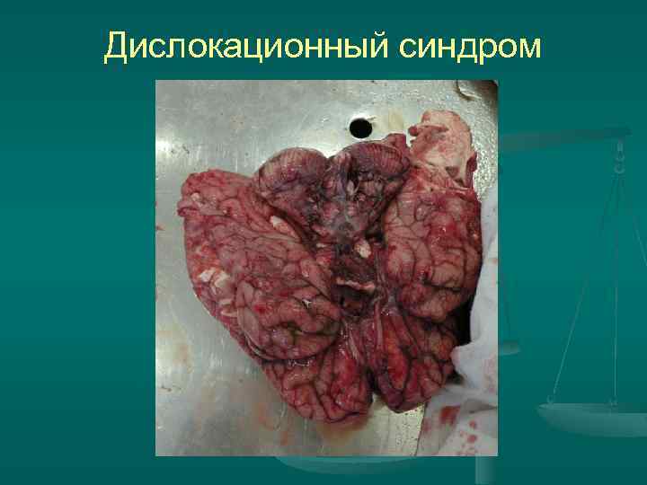 Дислокационный синдром 