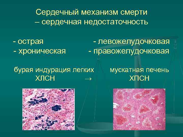 Сердечный механизм смерти – сердечная недостаточность - острая - хроническая - левожелудочковая - правожелудочковая