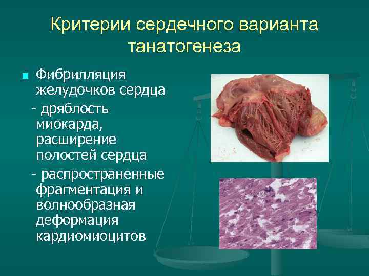Критерии сердечного варианта танатогенеза Фибрилляция желудочков сердца - дряблость миокарда, расширение полостей сердца -