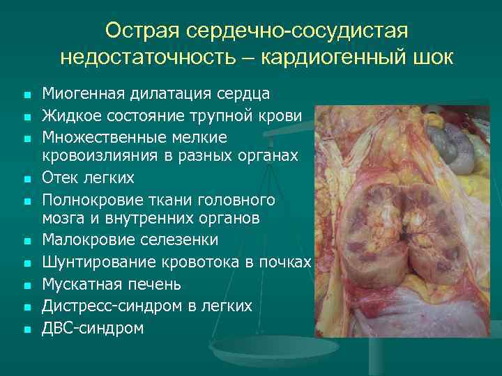 Острая сердечно-сосудистая недостаточность – кардиогенный шок n n n n n Миогенная дилатация сердца