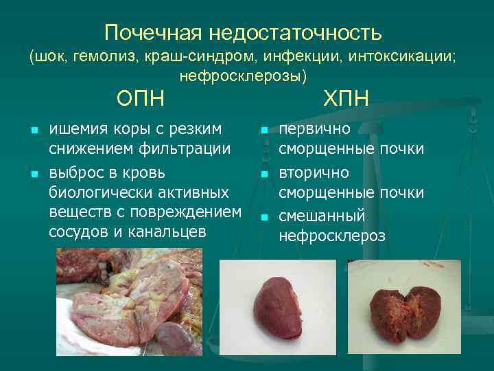 Почечная недостаточность (шок, гемолиз, краш-синдром, инфекции, интоксикации; нефросклерозы) ОПН n n ишемия коры с