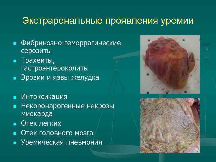 Экстраренальные проявления уремии n n n n Фибринозно-геморрагические серозиты Трахеиты, гастроэнтероколиты Эрозии и язвы