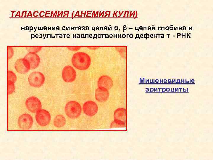 ТАЛАССЕМИЯ (АНЕМИЯ КУЛИ) нарушение синтеза цепей α, β – цепей глобина в результате наследственного