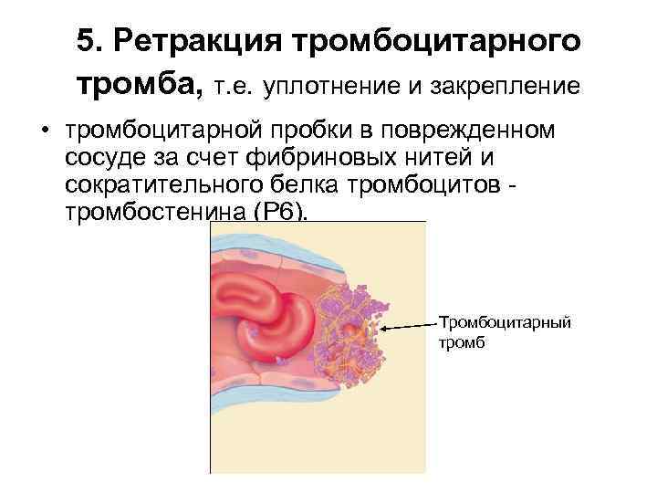 5. Ретракция тромбоцитарного тромба, т. е. уплотнение и закрепление • тромбоцитарной пробки в поврежденном