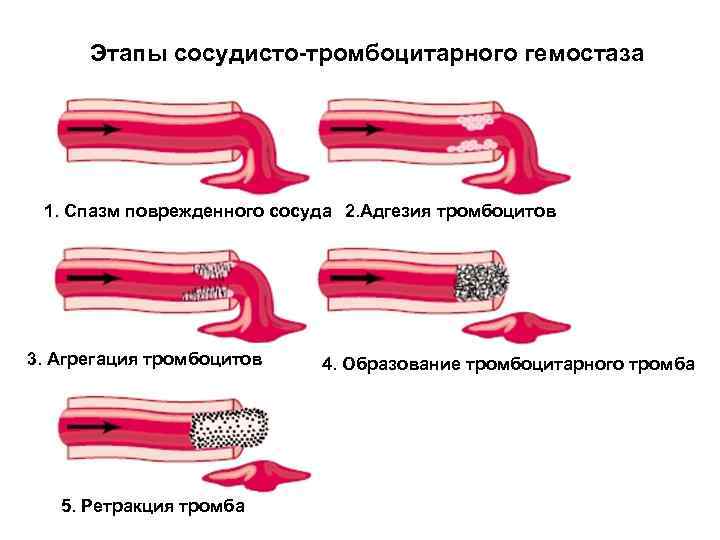 Этапы сосудисто-тромбоцитарного гемостаза 1. Спазм поврежденного сосуда 2. Адгезия тромбоцитов 3. Агрегация тромбоцитов 5.