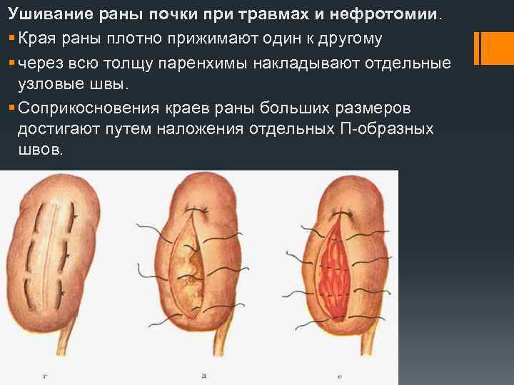 Ушивание раны почки при травмах и нефротомии. § Края раны плотно прижимают один к