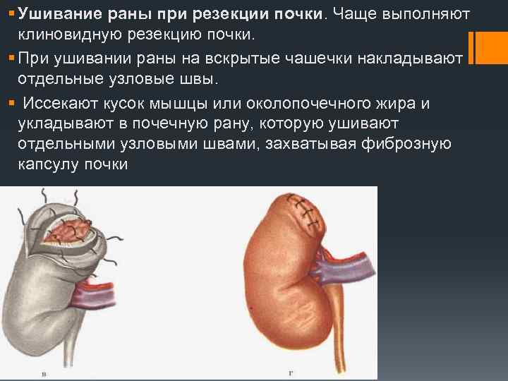 § Ушивание раны при резекции почки. Чаще выполняют клиновидную резекцию почки. § При ушивании
