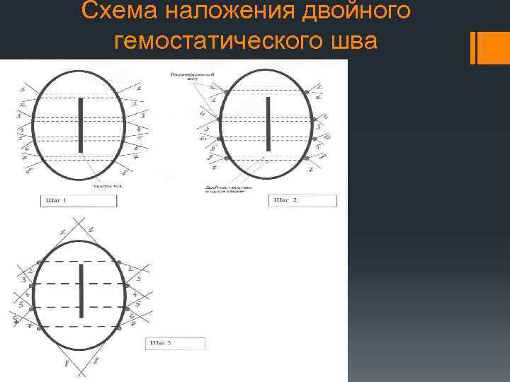 Схема наложения двойного гемостатического шва 
