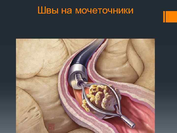 Швы на мочеточники 