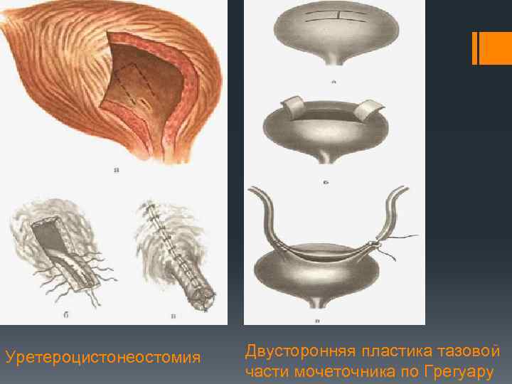 Меатомия члена фото