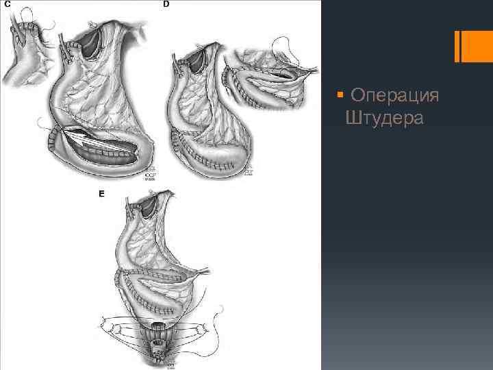 § Операция Штудера 