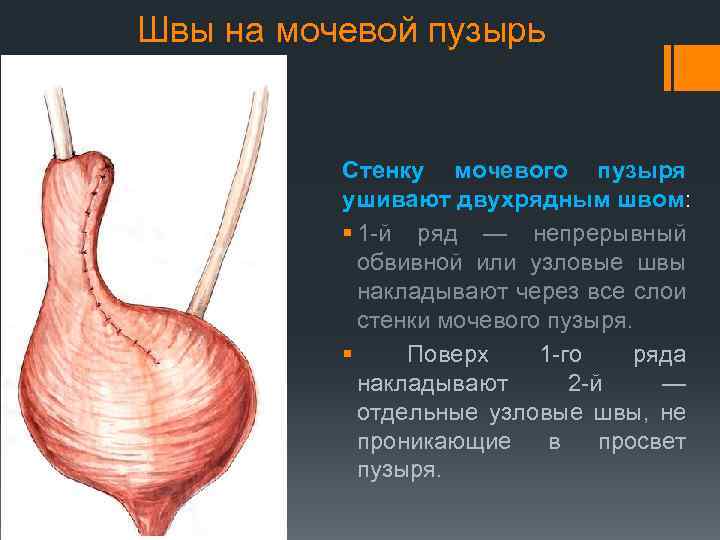 Швы на мочевой пузырь Стенку мочевого пузыря ушивают двухрядным швом: § 1 -й ряд