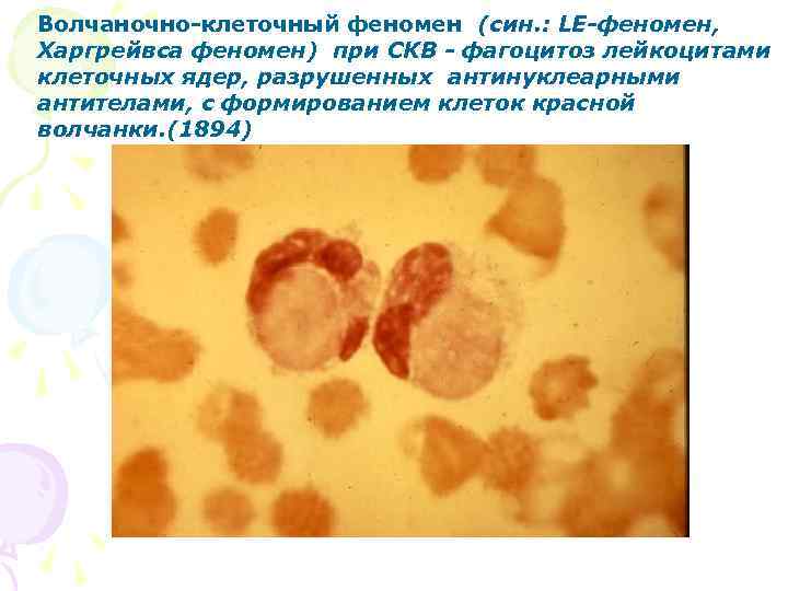  Волчаночно клеточный феномен (син. : LE-феномен, Харгрейвса феномен) при СКВ - фагоцитоз лейкоцитами
