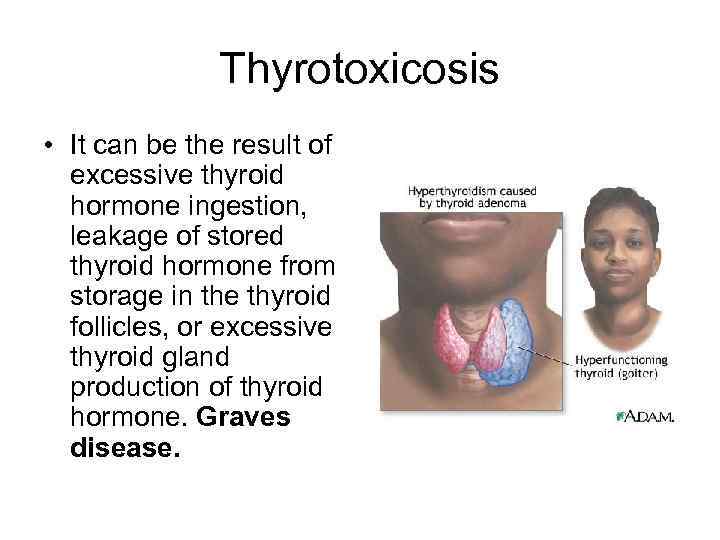 Thyrotoxicosis • It can be the result of excessive thyroid hormone ingestion, leakage of