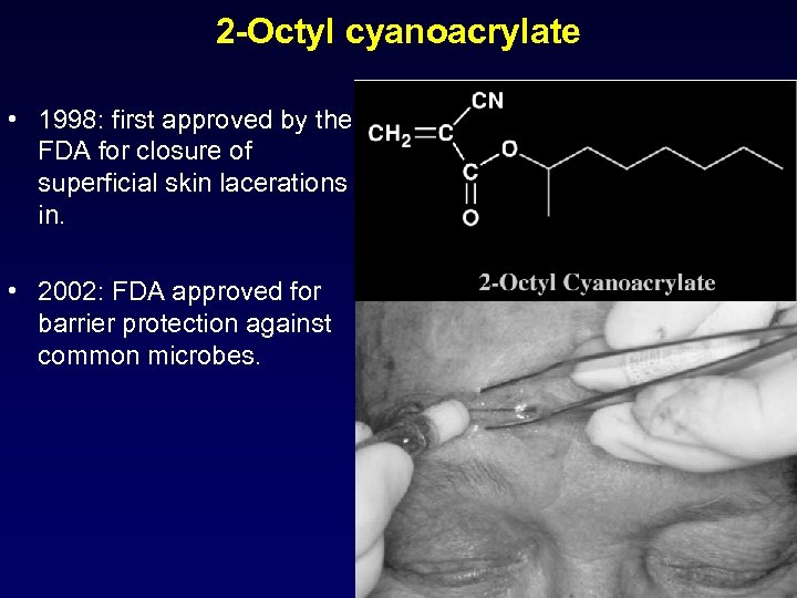 2 -Octyl cyanoacrylate • 1998: first approved by the FDA for closure of superficial