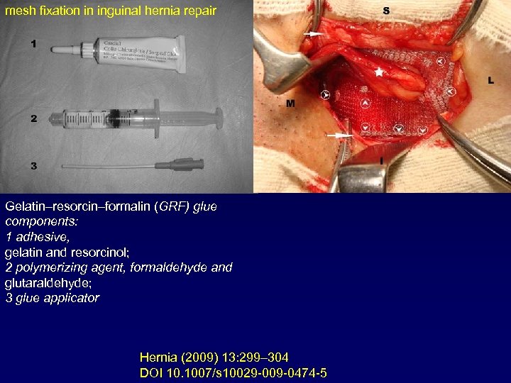 mesh fixation in inguinal hernia repair Gelatin–resorcin–formalin (GRF) glue components: 1 adhesive, gelatin and