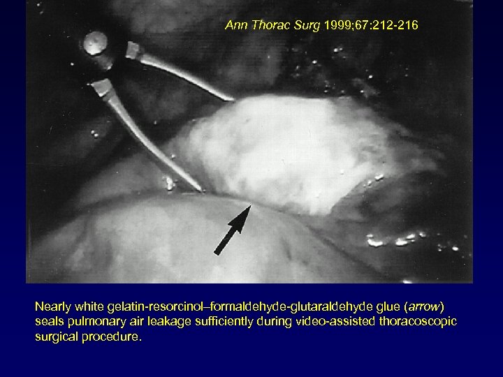 Ann Thorac Surg 1999; 67: 212 -216 Nearly white gelatin-resorcinol–formaldehyde-glutaraldehyde glue (arrow) seals pulmonary