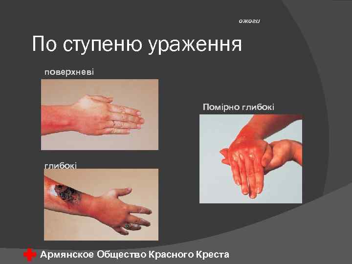 ожоги По ступеню ураження поверхневі Помірно глибокі Армянское Общество Красного Креста 