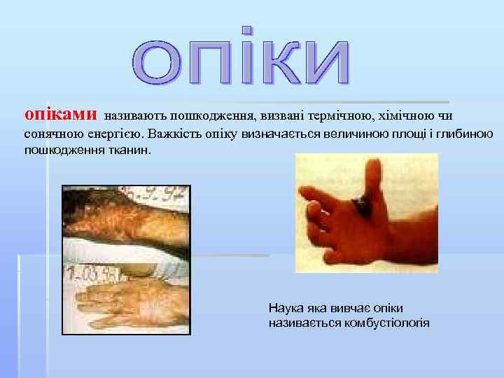 опіками називають пошкодження, визвані термічною, хімічною чи сонячною енергією. Важкість опіку визначається величиною площі