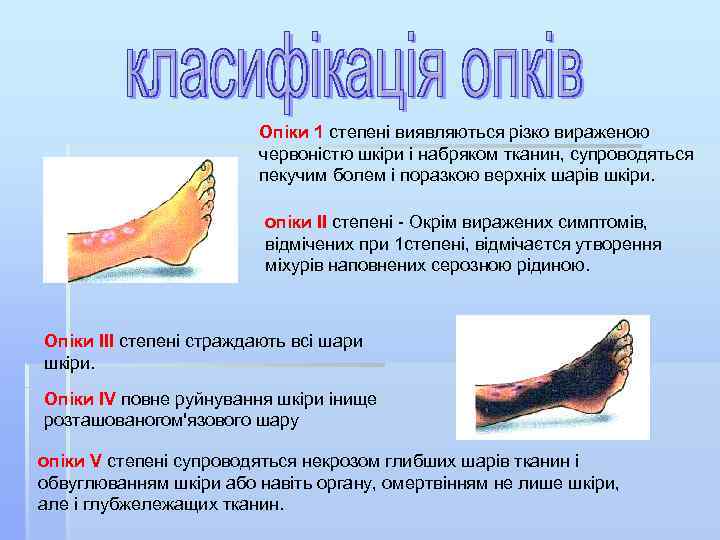 Опіки 1 степені виявляються різко вираженою червоністю шкіри і набряком тканин, супроводяться пекучим болем