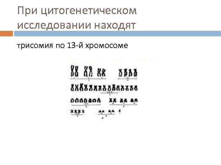 При цитогенетическом исследовании находят трисомия по 13 -й хромосоме 